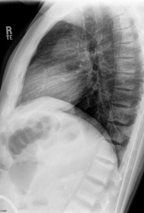 chronic-renal-disease